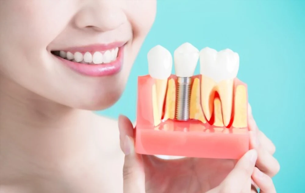 dental implant