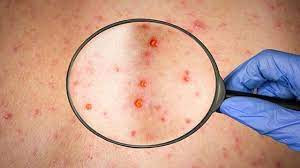 monkeypox2022, monkeypox symtoms, is monkeypox dangerous,monkeypox cure, monkeypox cases, monkeypox pictures, monkeypox vaccine, monkeypox deadly, monkeypox outbreak2022,