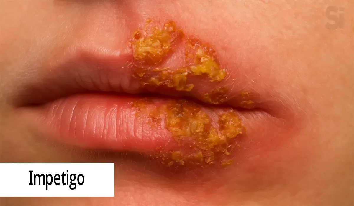 Impetigo