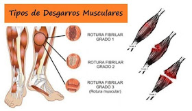 Cuerpo en Forma, desgarro muscular, porque duele el desgarro muscular, prevenir lesiones en el ejercicio, sintoma del desgarro, tipos de desgarro muscular