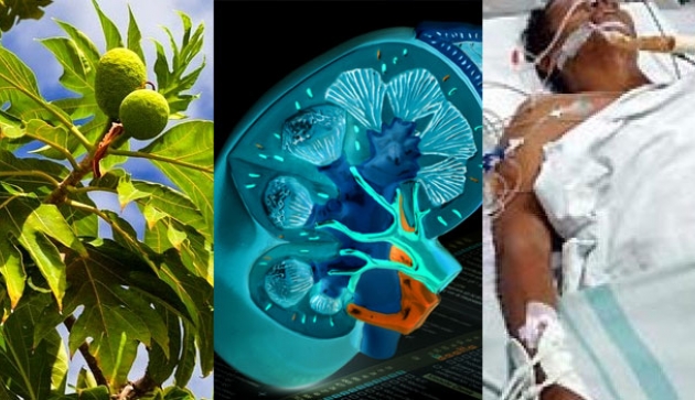 Already Found Natural Remedy for Kidney Failure without Having to Wash Blood