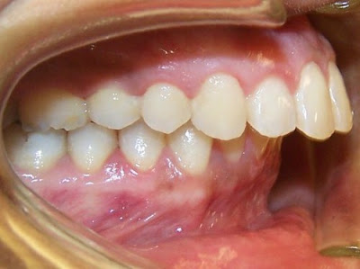  Răng lệch khớp cắn có tác hại gì?