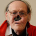 71-year-old pensioner has been living without a nose for eight years (Graphic photos) 