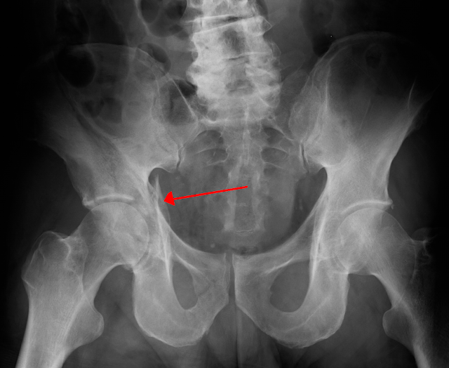 acetabular-fracture-treatment-acetabulum-fracture-symptom