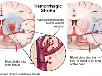 Obat Penyakit Stroke Ringan