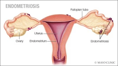 Endometriosis