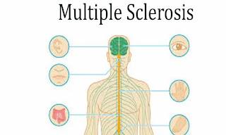 Multiple Sclerosis