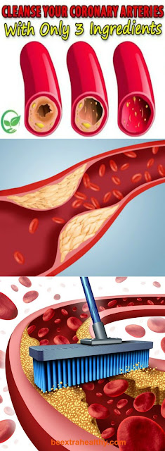 Clean Coronary Artery With Only 3 Ingredients