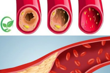 Clean Coronary Artery With Only 3 Ingredients