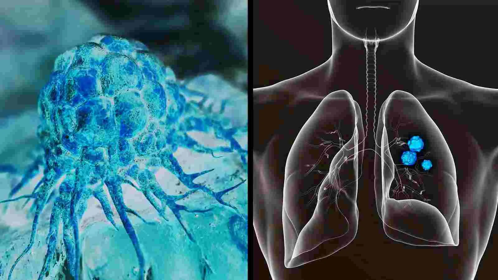 Oncologists Explain 13 Lung Cancer Symptoms to Never Ignore