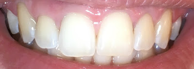 example of my teeth after using the carbon coco kit for 5 nights