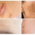 Home Remedies to Remove Scars Quickly And Naturally