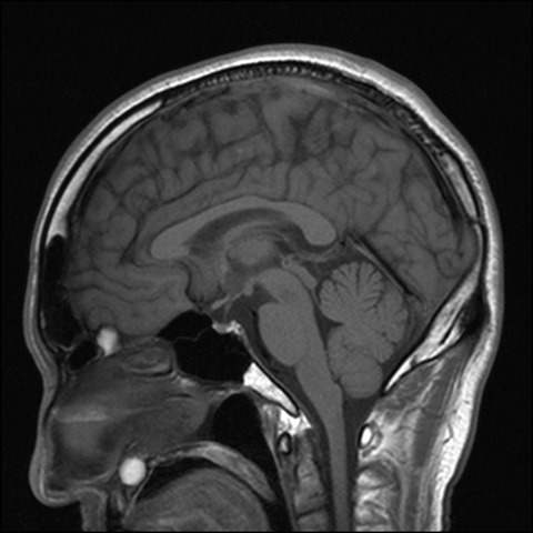 nasopalatine-duct-cyst-MRI-0001 nasopalatine-duct-cyst-MRI-0001