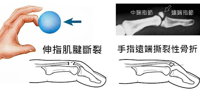 #Mallet finger #鎚狀指  #槌狀指槌#手指扭傷 #手指肌腱斷裂  #吃蘿蔔乾 #運動復健 #治療 #李嘉瑋醫師 #復健加油站