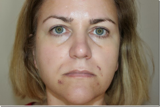 Radiesse 24 hours after injection picture 1