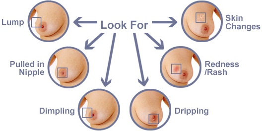 What Inflammatory Breast Cancer Looks Like / Breast Cancer Topic: Peau d'orange pics. Is this what it ... : The breast can also be painful in inflammatory breast cancer, but this is not always the case.