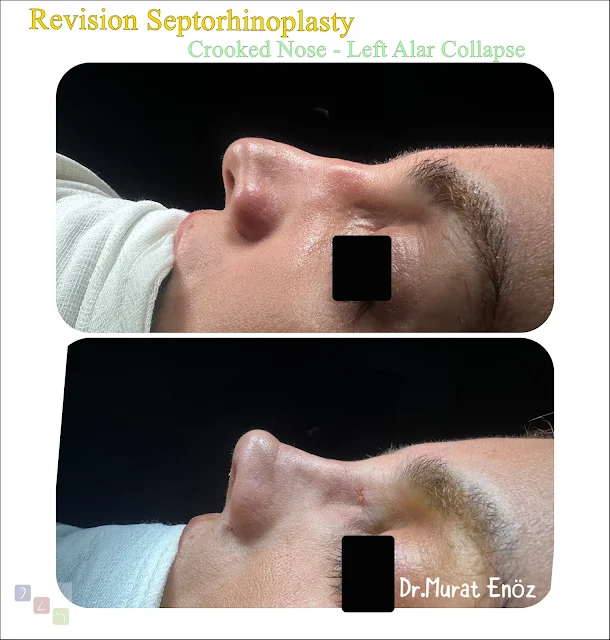 Revision Septorhinoplasty For Treatment of Crooked Nose - Left Alar Collapse