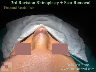 revision rhinoplasty, scar removal, complex surgery, nasal reconstruction, secondary rhinoplasty, plastic surgery, nasal aesthetics, surgical revision, rhinoplasty techniques, scar treatment, nose job revision, nasal anatomy, facial plastic surgery, surgical scars, aesthetic surgery, cosmetic enhancement, rhinoplasty recovery, nasal deformity, corrective surgery, scar management