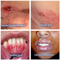 10 Tanaman Obat Herpes Alami Paling Manjur Anda Harus Mencobanya