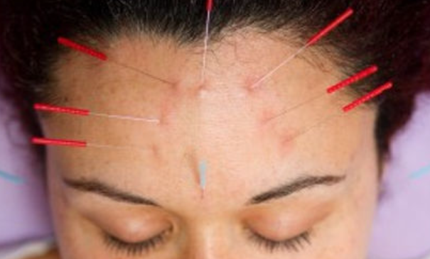 The Ancient Art of Acupuncture, A Modern Solution for Hormonal Acne.