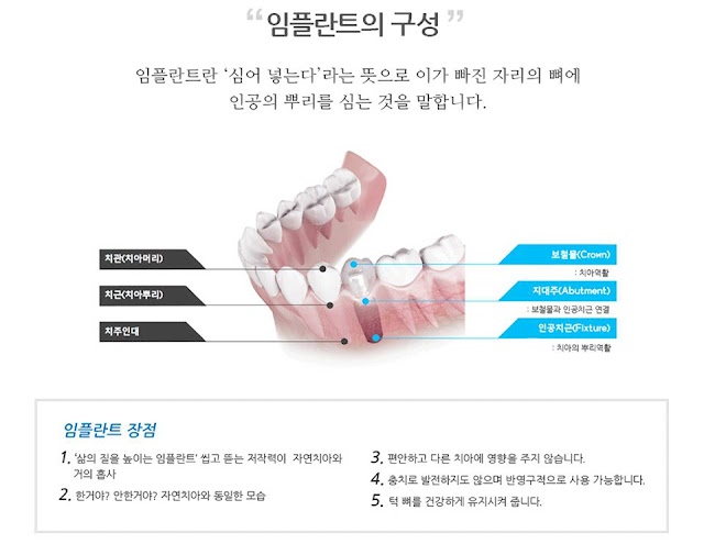 임플란트 수술의 단계별 과정 안내