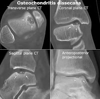 Osteochondritis dissecans(OCD)