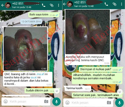 Obat Cantengan Bernanah / Jempol Kaki Bernanah & Bengkak Yang Ampuh