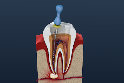Are Root Canals Effective