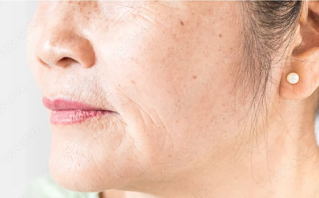 Lip Wrinkles : Effective Home Remedies to Control Wrinkles around the Lips