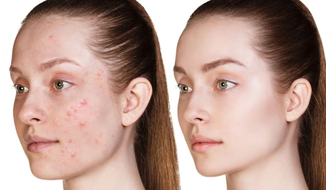 Some Simple Tips For Those of You Who Battle With Great Advice That Can Help You To Get Rid Of Your Acne