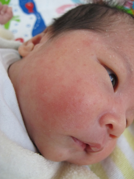 乳児湿疹と脂漏性湿疹 Mayblog 乳児湿疹と脂漏性湿疹 Mayblog