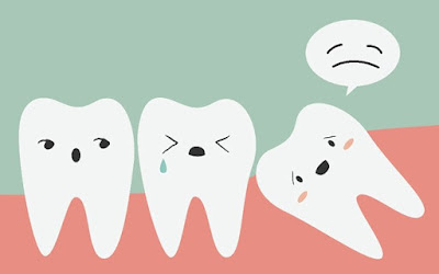Vì sao nên nhổ răng số 8 mọc ngầm mọc lệch?