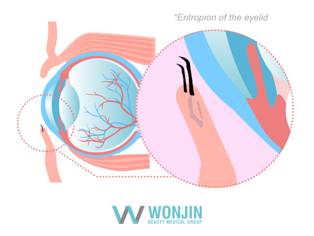 entropion  of the eyelid