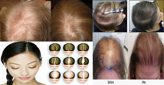 How To Stop Hair Loss And Grow Naturally Very Fast!