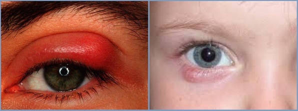 Eyelid Bump: Symptoms, Causes and Treatments