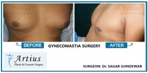 Gynecomastia Surgery in Navi Mumbai