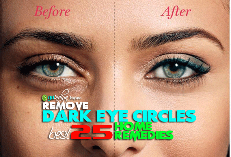 16 Home Remedies to Remove Dark Circles under Eyes, Puffy Eyes 