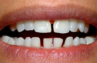 Các cách làm răng thẳng đều-3