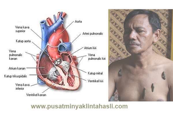 Terapi Lintah Penyakit Jantung