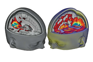 First LSD brain imaging study offers insights into consciousness