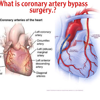 What is Coronary artery bypass surgery .?