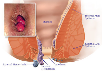 hemorrhoid