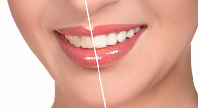 Cách làm trắng răng bị vàng tại nhà