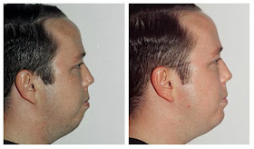 Chin Augmentation Before And After