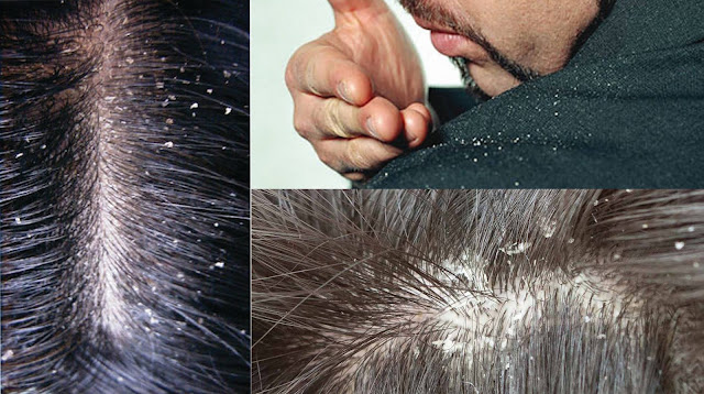 طريقة علاج قشرة الشعر بالأعشاب 