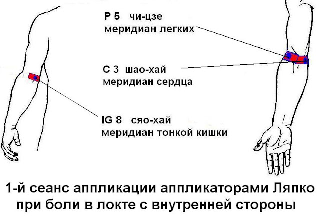 Почему может болеть локоть. Болевая точка с внутренней стороны локтя. Болевые точки на локтевом сгибе. Болевая точка на локтевом суставе. Боль в локте с внутренней стороны.