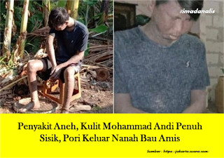 Penyakit Aneh, Kulit Mohammad Andi Penuh Sisik, Pori Keluar Nanah Bau Amis