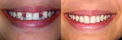 http://www.bangaloredentistimplant.com/implant-dentistry/