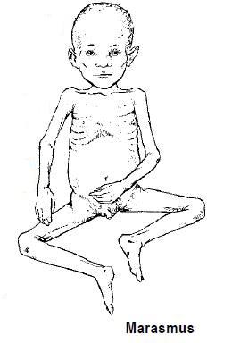 marasmus - Is the child looked very thin