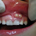 Phân tích sưng chân răng có sao không từ nha khoa